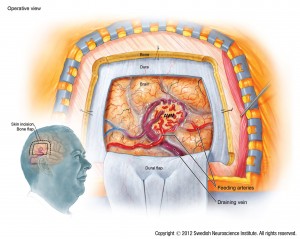 Cerebral Arteriovenous Malformations - SeattleNeurosciences.com